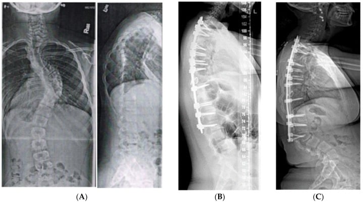 Radiographs showing distal junctional kyphosis after posterior spinal fusion