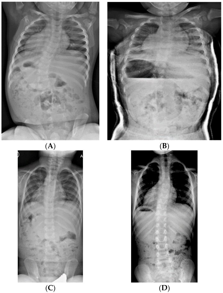 Serial radiographs showing infantile scoliosis correction with casting and bracing