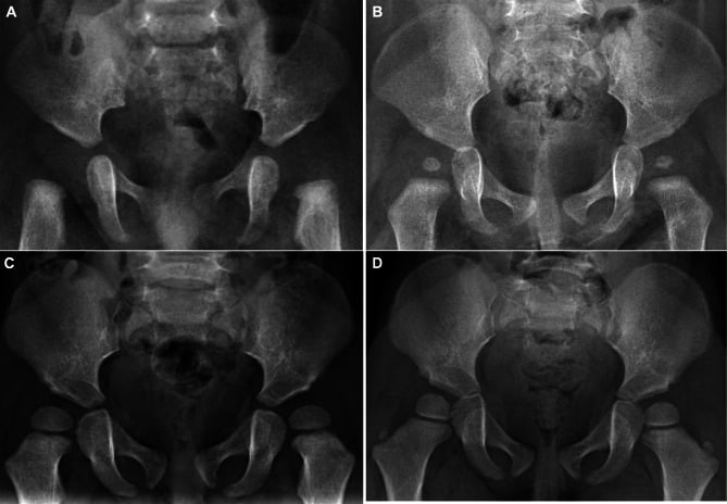 Serial AP pelvis radiographs showing developmental hip dysplasia treatment in children with Prader-Willi syndrome