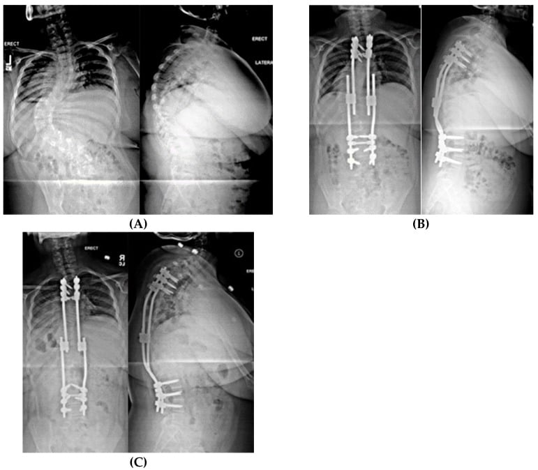 Radiographs showing staged correction with non-fusion spinal instrumentation