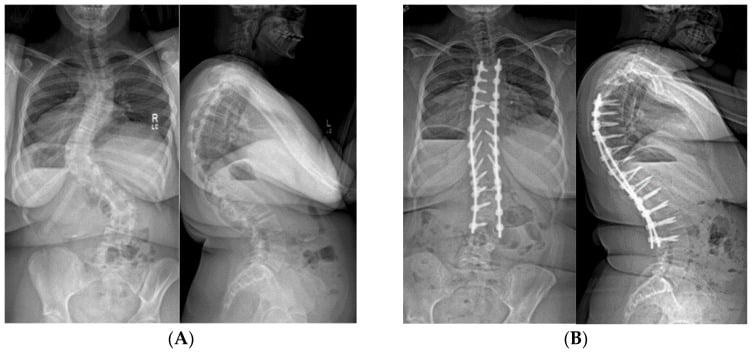 Radiographs before and four years after posterior spinal fusion