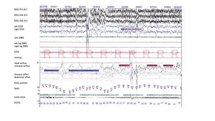 Polysomnography showing sleep-disordered breathing and oxygen desaturation