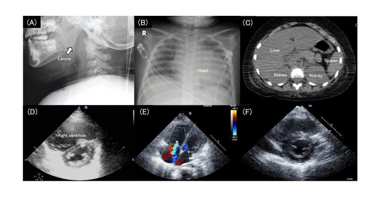 Airway and cardiopulmonary imaging during respiratory decompensation