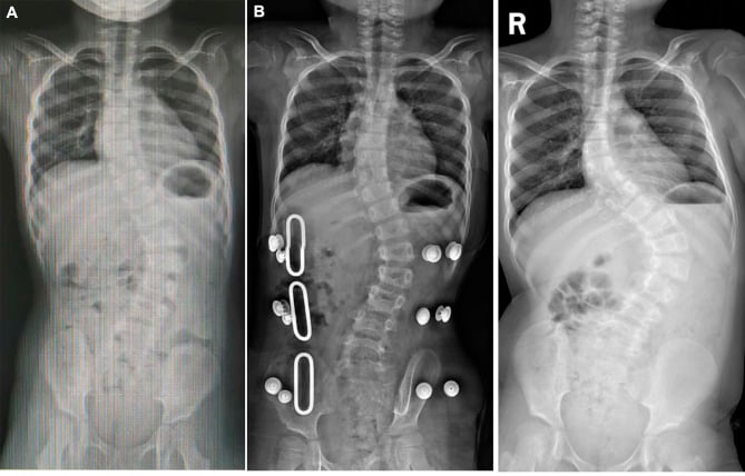 Serial spine radiographs of a child with Prader-Willi syndrome showing scoliosis before, during and after brace treatment