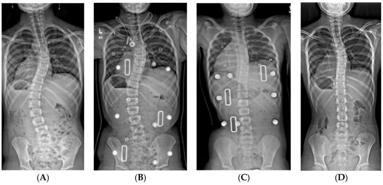 Serial radiographs showing scoliosis correction in daytime and night-time braces