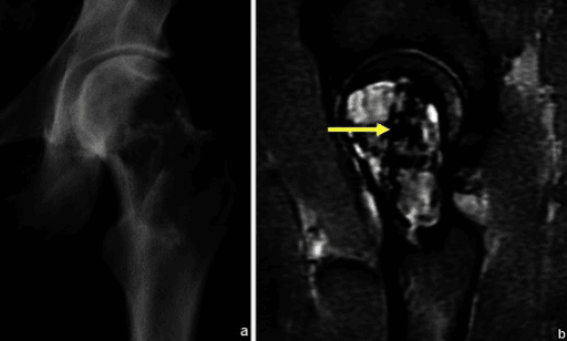 Coronal T2-weighted MRI of the proximal femur showing a bright lesion containing darker low signal areas, alongside a matching radiograph.