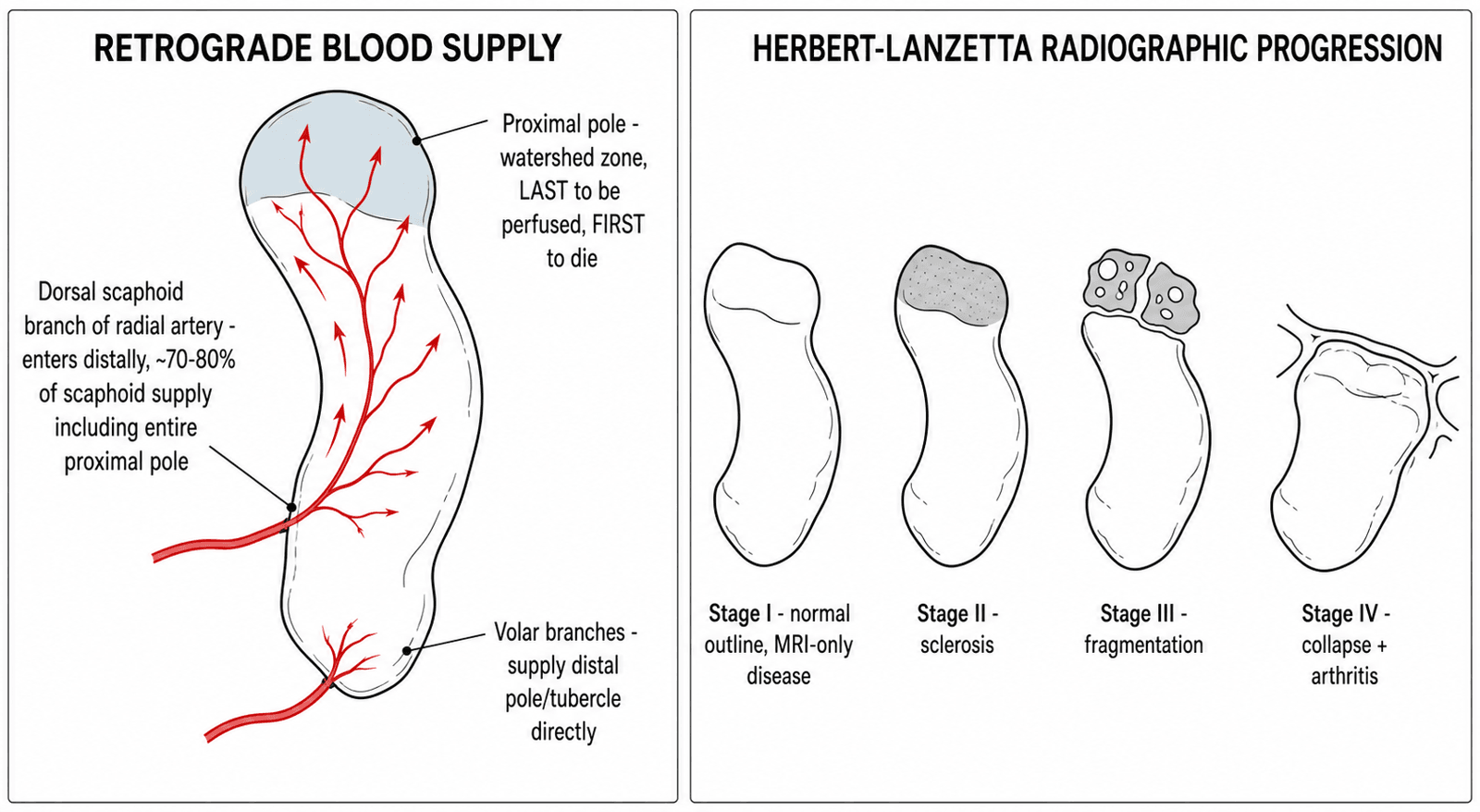 Schematic diagram of the scaphoid's retrograde blood supply and the four Herbert-Lanzetta radiographic stages
