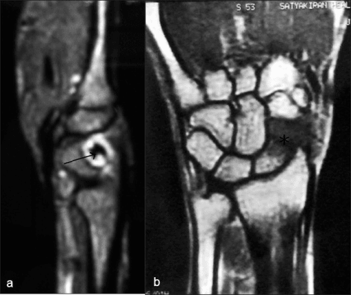 Two-panel wrist MRI; sagittal panel shows low-signal osteonecrotic focus in distal scaphoid marked by arrow, coronal panel shows carpus