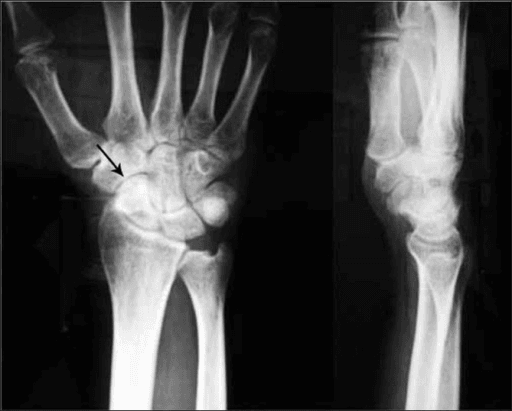 Two-panel wrist radiograph; AP view with arrow at dense scaphoid, lateral view alongside