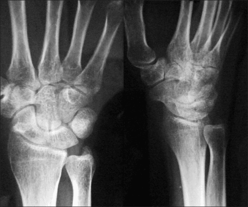 Two-panel follow-up wrist radiographs showing carpus with normalised scaphoid density after two years