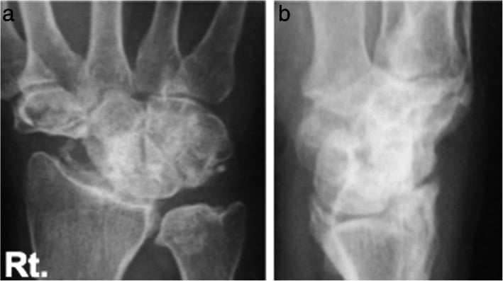 Posteroanterior and lateral wrist radiographs showing united four-corner fusion