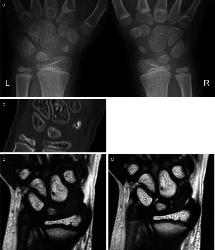 Paediatric wrist radiographs, CT and MRI showing sclerosis, segmentation and diffuse low signal of an incompletely ossified scaphoid