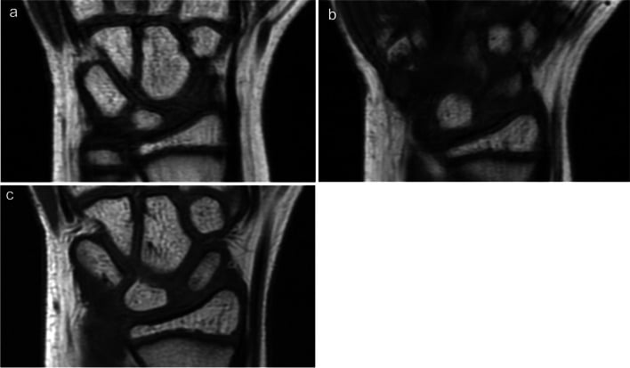 Serial T1 MRI showing distal then whole-scaphoid marrow signal recovery