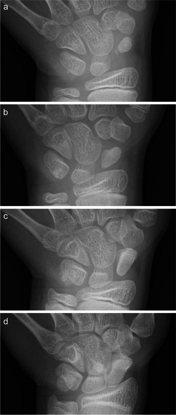 Serial paediatric wrist radiographs showing progressive remodelling and growth of the scaphoid over five years