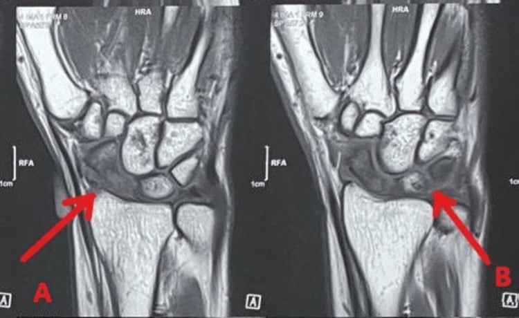 Coronal wrist MRI showing altered marrow signal in the scaphoid and other carpal bones