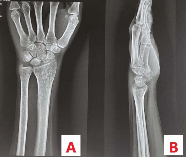 Posteroanterior and lateral wrist radiographs without visible scaphoid abnormality