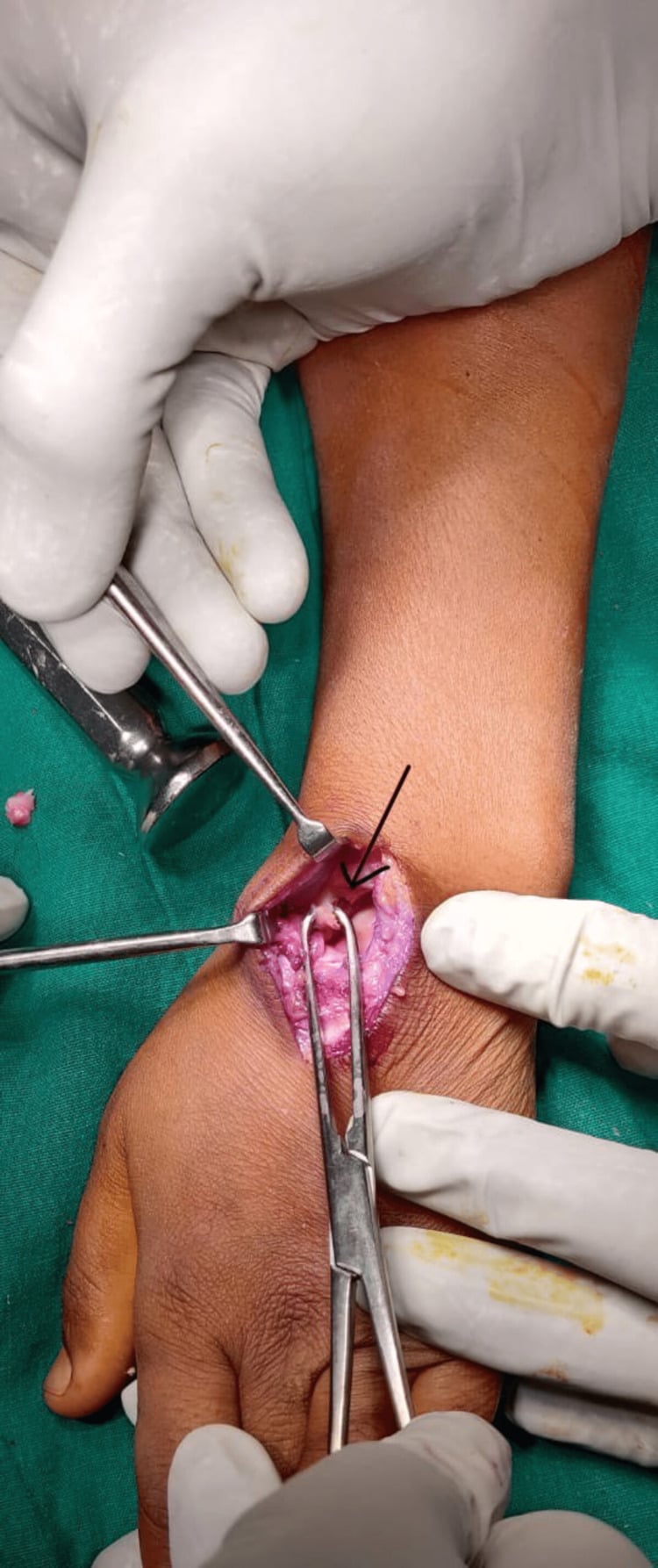 Draped dorsal wrist operative field during excision of the proximal carpal row