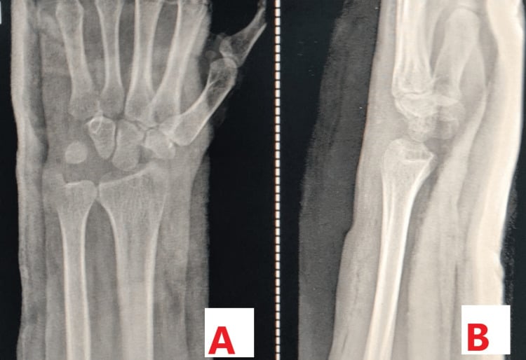 Postoperative posteroanterior and lateral wrist radiographs after proximal row carpectomy