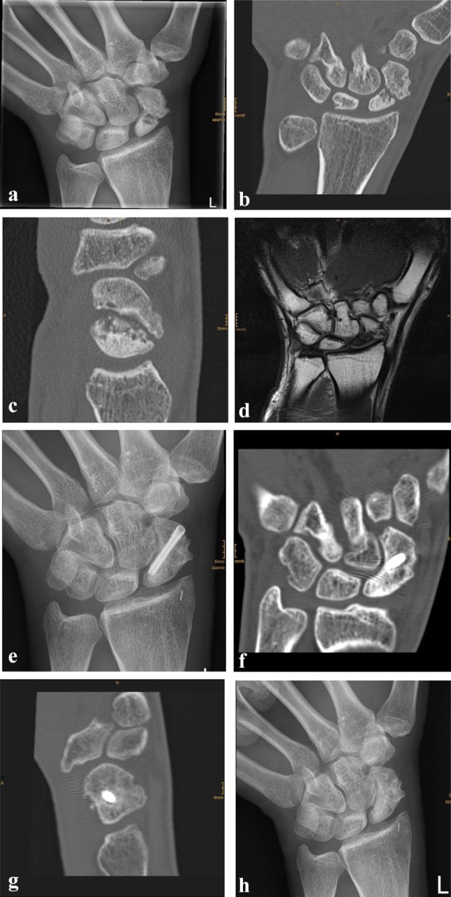 Radiographs, CT and contrast MRI showing scaphoid nonunion with secondary proximal-pole osteonecrosis and later graft union