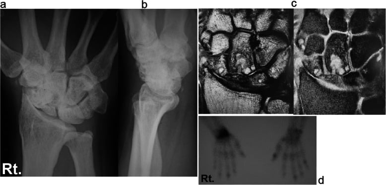 Radiographs, CT and bone scan of a scaphoid nonunion advanced collapse wrist