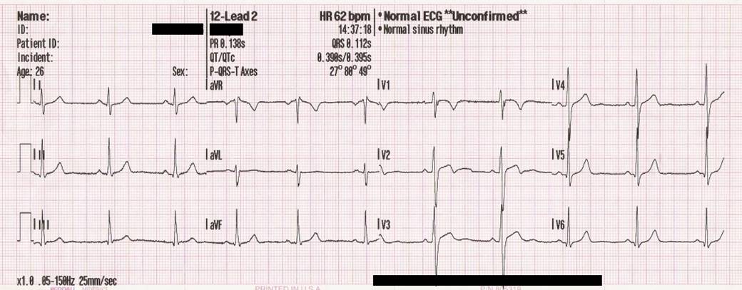 Normal 12-lead electrocardiogram showing sinus rhythm