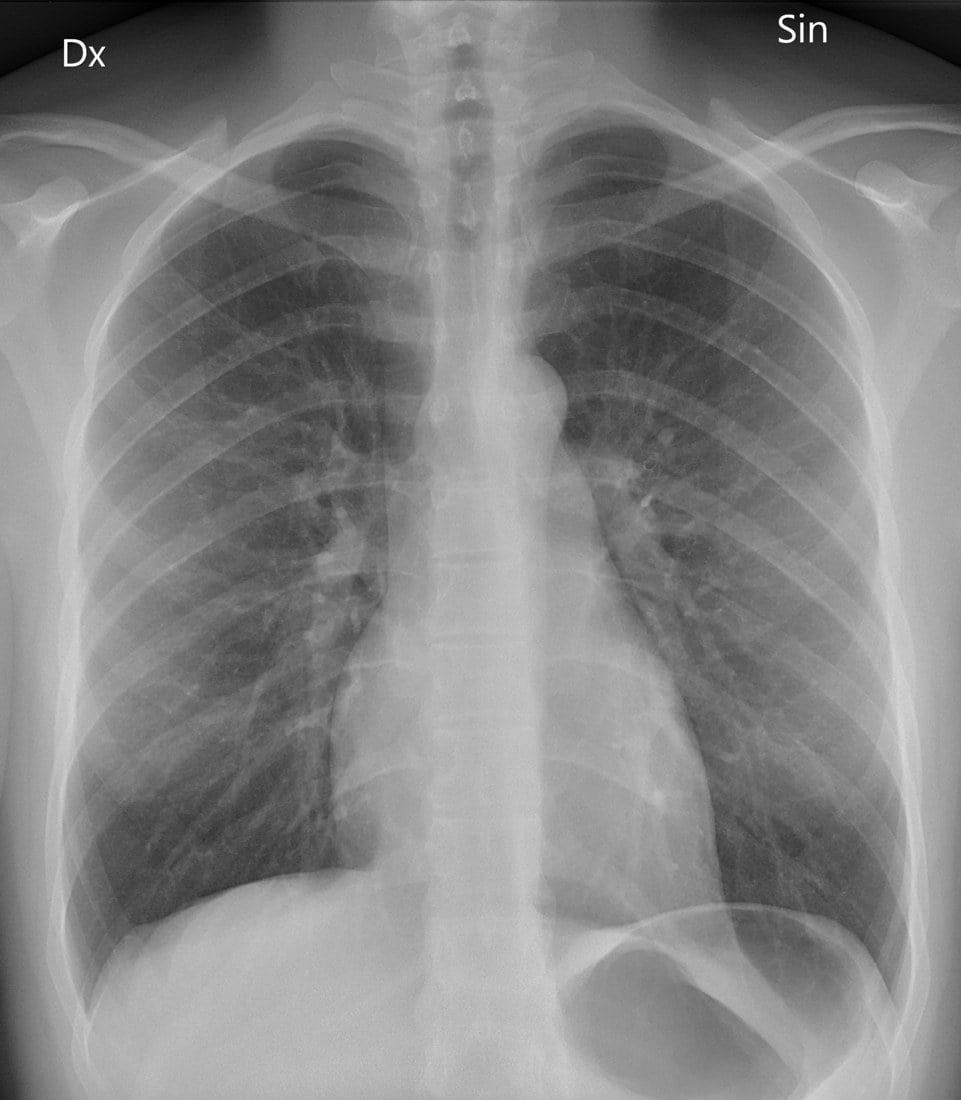 Normal posteroanterior chest radiograph