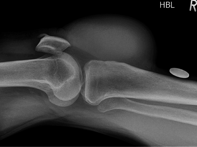 Horizontal-beam lateral knee radiograph showing a prepatellar soft-tissue opacity without bony abnormality