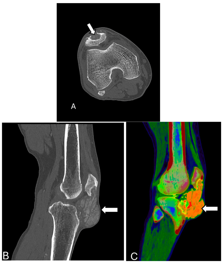 Axial and sagittal CT of the knee showing a large patellar and prepatellar gouty tophus of urate density