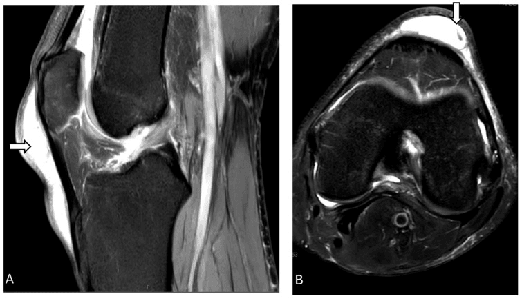 Sagittal and axial proton-density fat-suppressed MRI showing fluid in the prepatellar and infrapatellar bursae