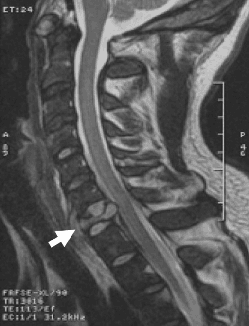 Sagittal T2 cervical spine MRI with a vertebral lesion and cord compression