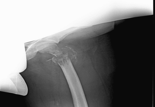 AP radiograph of the proximal femur showing a permeative destructive lesion
