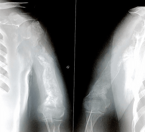 Two radiographic panels of the humerus showing a destructive diaphyseal lesion