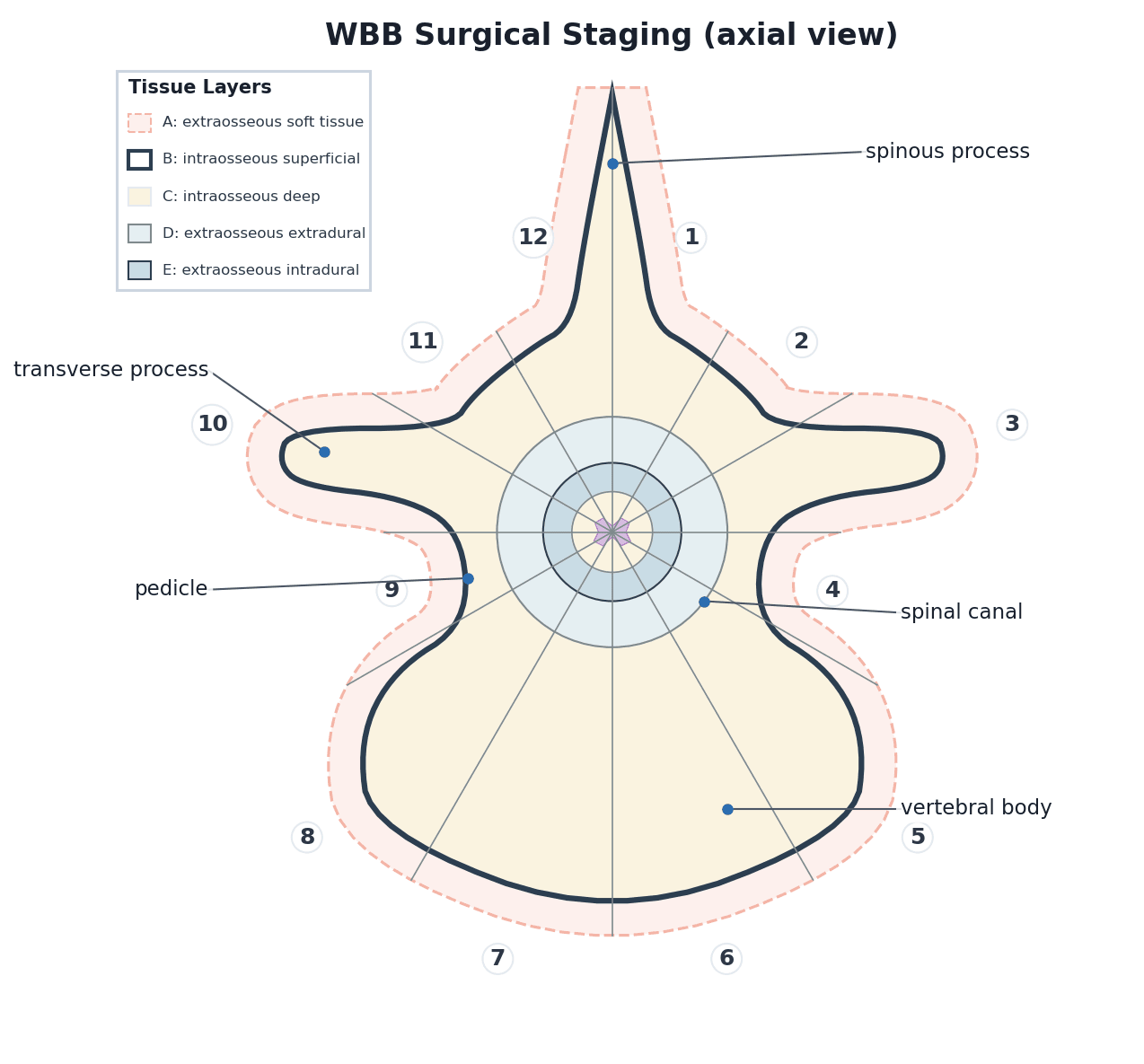 Axial diagram of the Weinstein-Boriani-Biagini (WBB) spinal tumour staging system with 12 radial sectors and tissue layers A to E