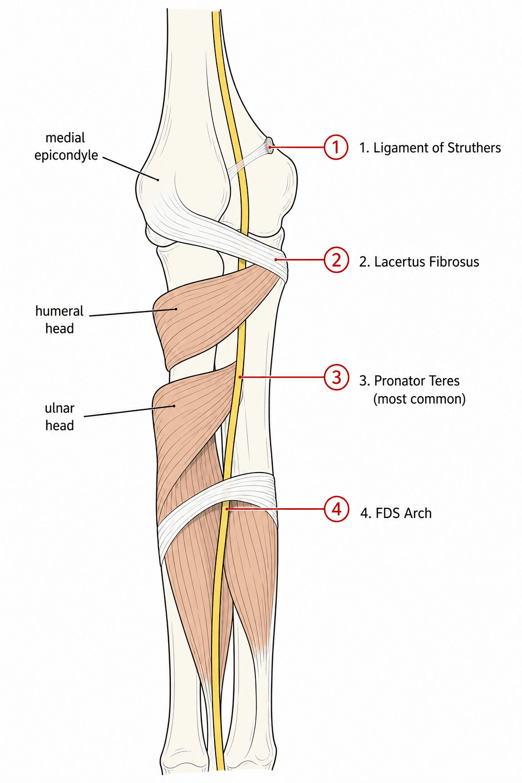 Anterior elbow and forearm schematic showing the median nerve's course through four potential compression sites
