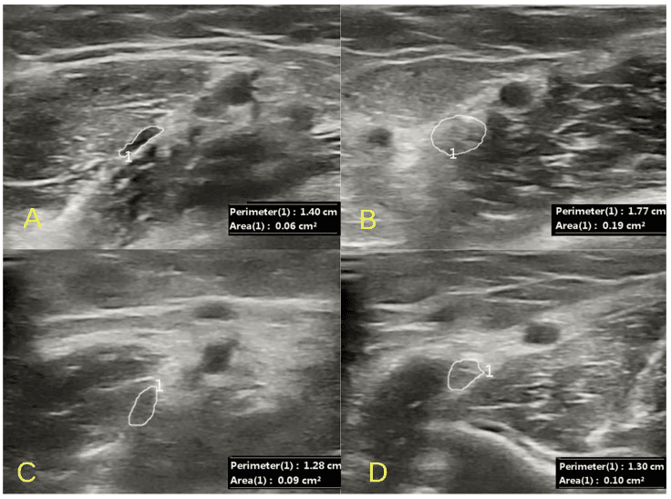 Four ultrasound panels, A to D, with the median nerve outlined and its perimeter and area printed, before and after release