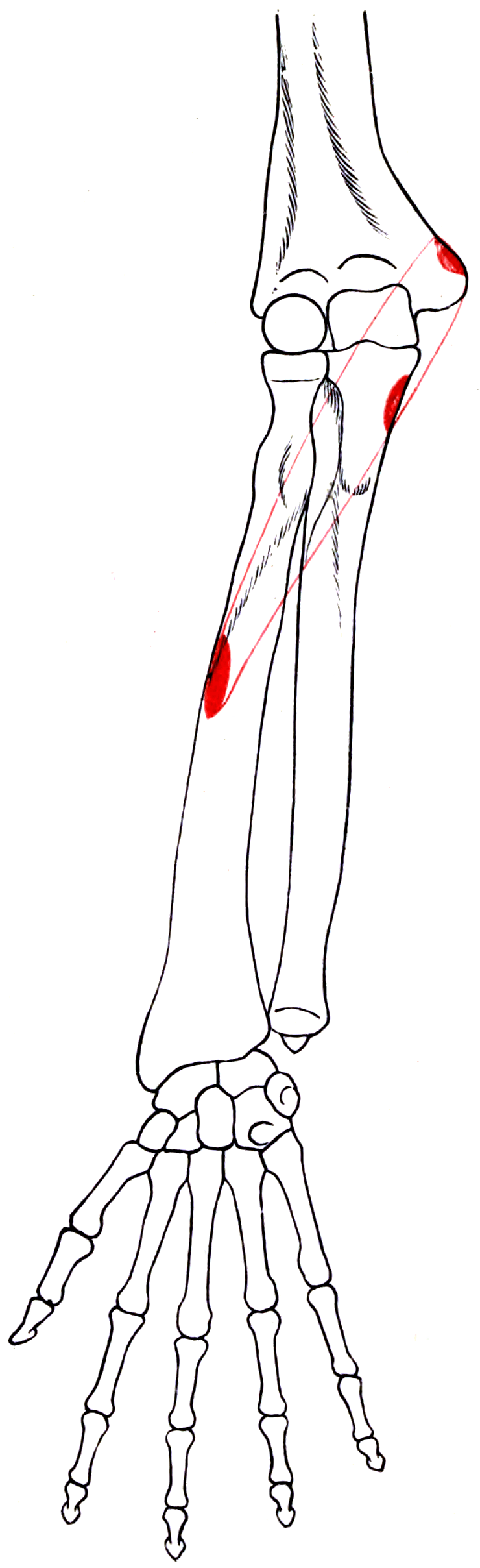 Diagram of the right humerus, radius and ulna with the outline and shaded attachment areas of pronator teres marked.