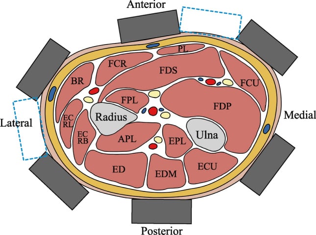 Cross-section of a forearm with labelled flexor and extensor muscles and surface EMG electrode positions