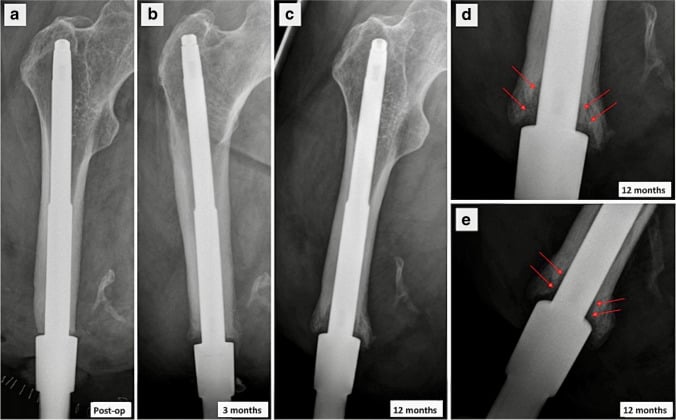 Serial AP and lateral radiographs showing progressive lucency around an infected transfemoral osseointegration implant