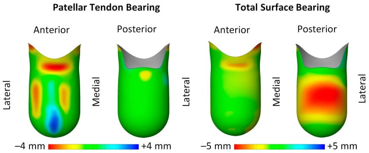 Anterior and posterior colour maps comparing PTB and TSB transtibial socket rectification