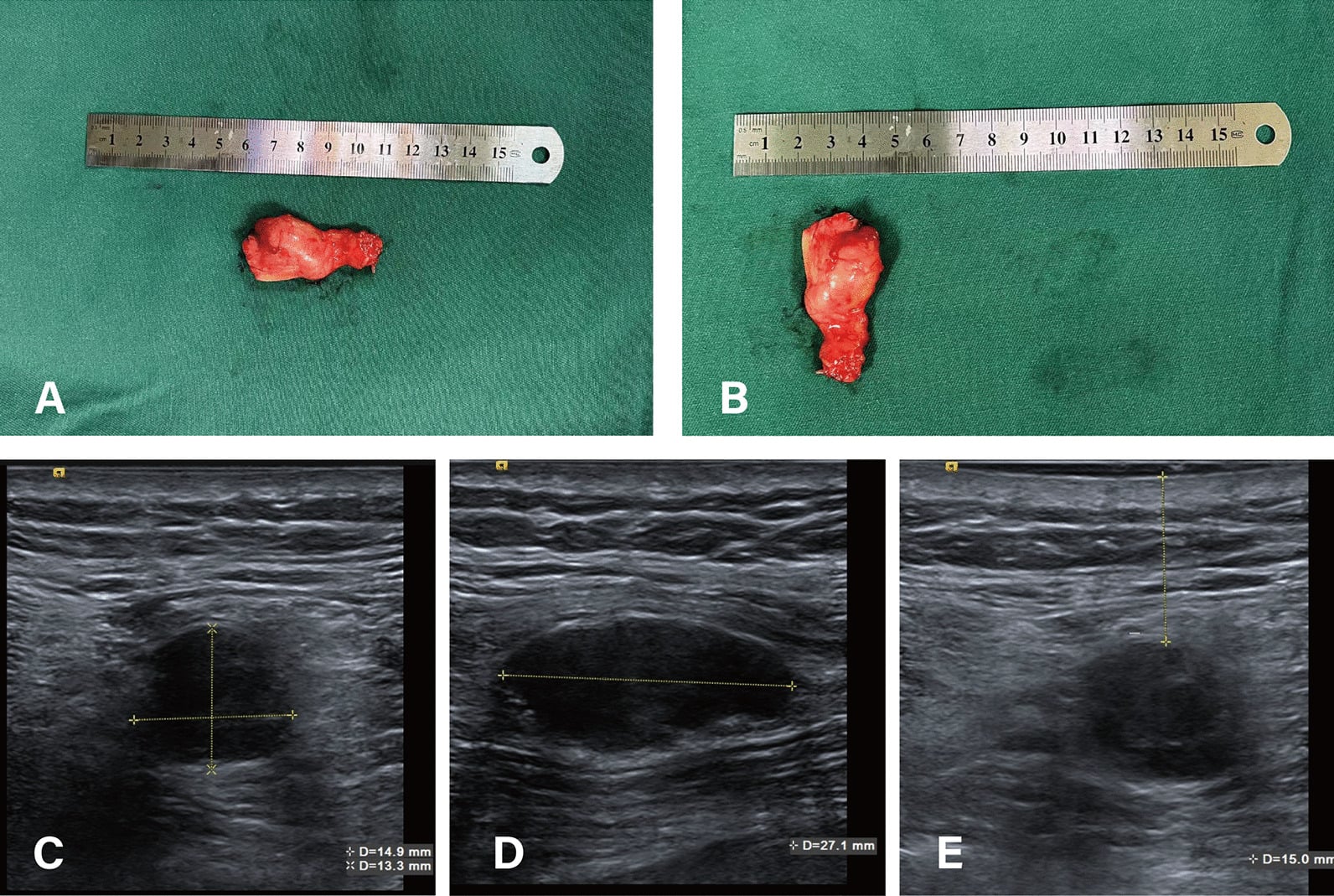 Excised traumatic neuroma beside longitudinal and transverse ultrasound images of the residual-limb nerve stump