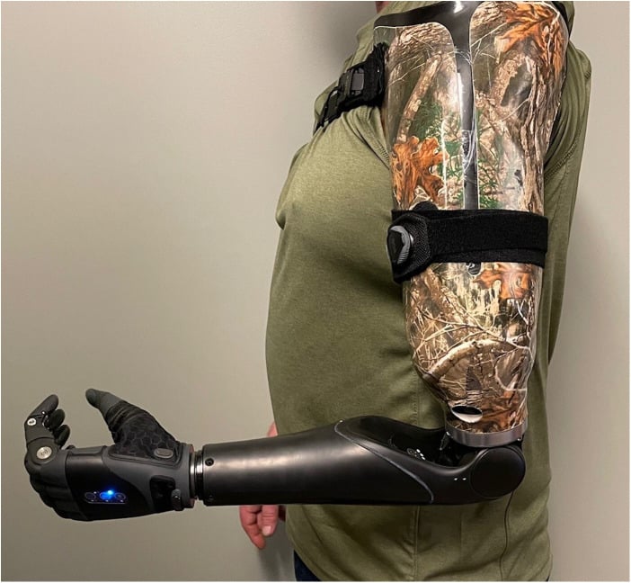 Clothed person wearing a transhumeral prosthesis with socket, elbow, forearm and multi-articulating hand