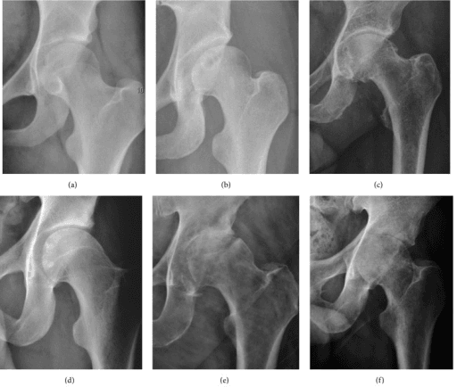 Six-panel radiographic series showing a spectrum of hip osteoarthritis from mild to advanced joint space loss, osteophytes and sclerosis