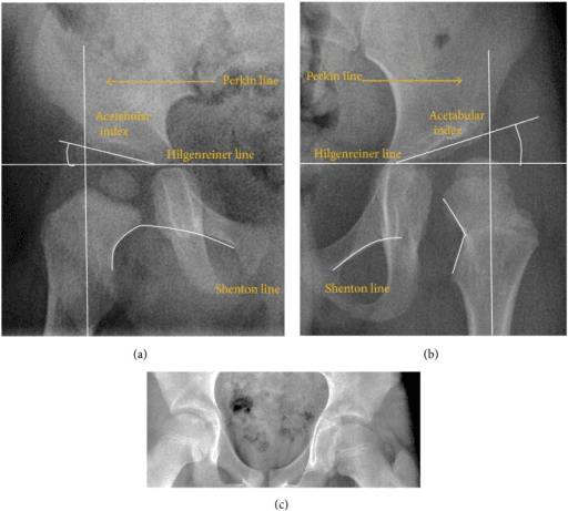 Annotated AP pelvis radiograph labelling the iliopectineal line, ilioischial line, Perkin line and Shenton line used to assess the hip