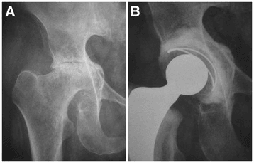 Two-panel hip radiograph - an arthritic hip with central acetabular wear and the same hip after a large-head metal reconstruction