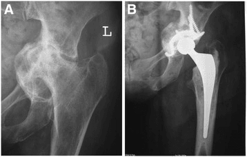 Two-panel left hip radiograph - panel A shows protrusio with the femoral head medialised deep into the acetabulum, panel B shows the same hip after total hip arthroplasty
