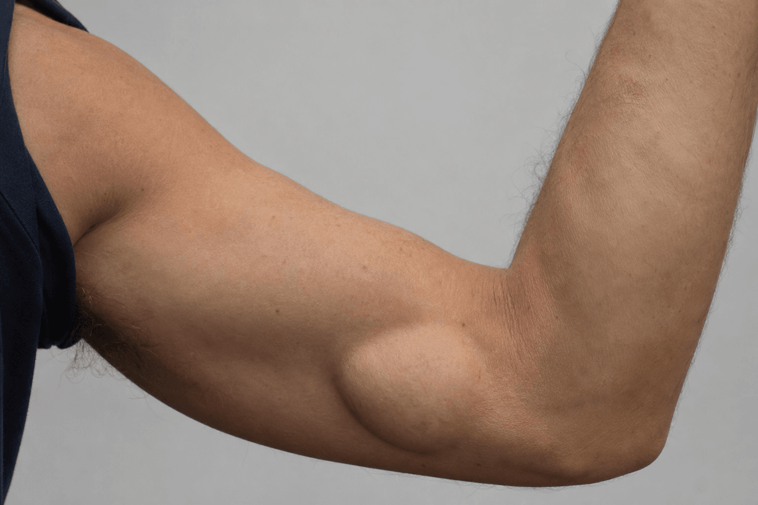 Clinical photograph of an arm showing the Popeye sign β a ball-like distal bulge of the biceps muscle belly after long head of biceps rupture.