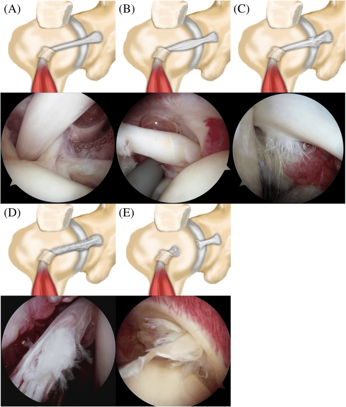 Five panels, A to E, each pairing a drawing of the long head biceps tendon with its arthroscopic appearance, from normal tendon through hourglass hypertrophy and partial fraying to a complex tear