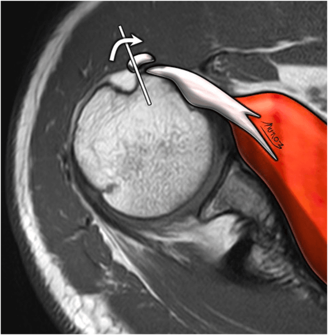 Axial shoulder MRI with a drawn overlay: the long head biceps tendon sits across a straight line at the groove margin, with a curved arrow marking its medial displacement toward a red-shaded muscle