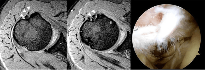 Two shoulder MR images with arrowheads on the long head biceps tendon at the groove, beside an arthroscopic view of a frayed complex tear