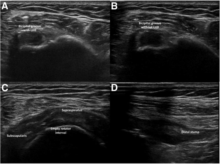 Four ultrasound panels: A the bicipital groove with the long head biceps, B the groove without it, C an empty rotator interval between subscapularis and supraspinatus, D the distal biceps stump after tenotomy
